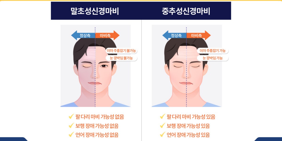 말초성 신경마비와 중추성 신경마비의 차이를 보여주는 비교 그림