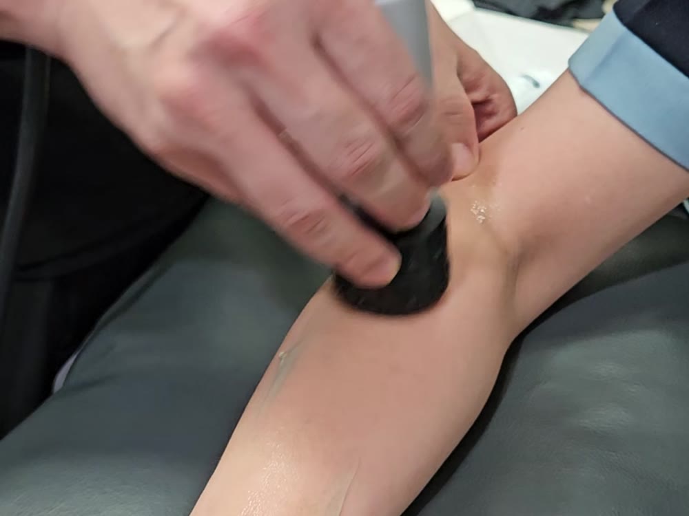 무릎 아래 정강이에 방사형 체외충격파를 대는 장면