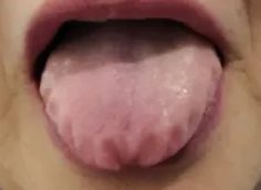 가장자리에 이 자국(치흔)이 남은 혀 — 설진 사진